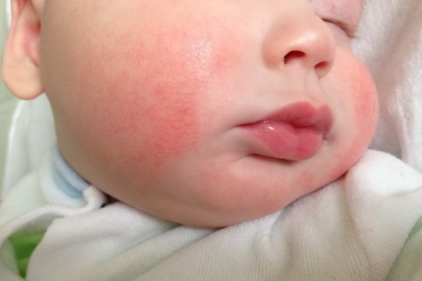 Аллергия на щеках у ребенка